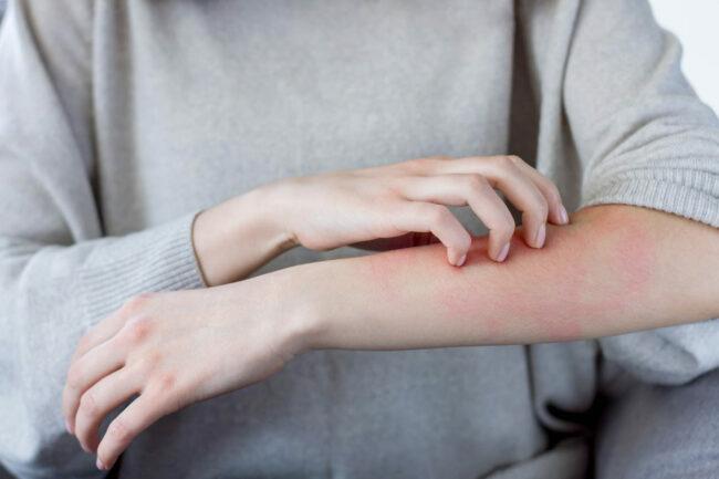 Kuidas mürgisuma välja näeb, põhjustab nahalöövet