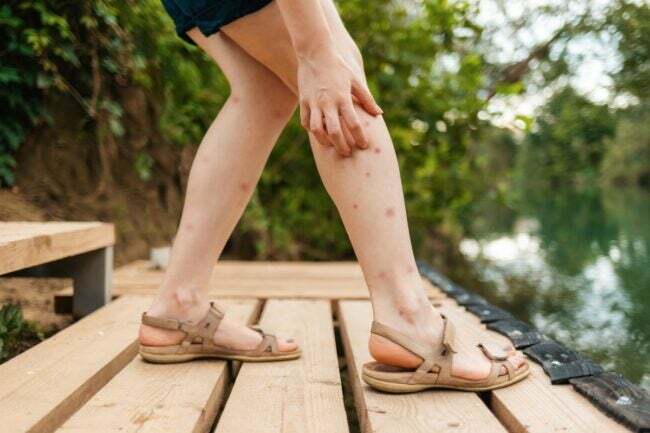 Sieviete, kas skrāpē moskītu kodumus uz viņas kājām